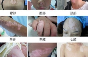 济南白癜风医院，正确诊断各部位白斑